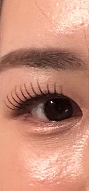 보톡스-맞은-이후