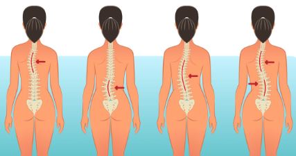 척추측만증-유형-이미지